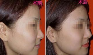 光子嫩肤祛斑价格大概是多少啊 光子嫩肤祛斑多少钱